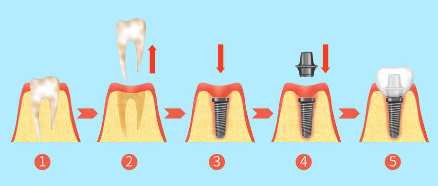 摄图网_401804272_wx_牙齿种植牙治疗过程步骤医疗插画（企业商用）